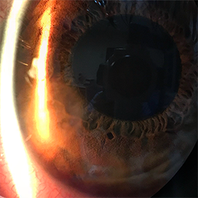 Операция по пересадке роговицы глаз thumbnail
