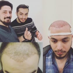 Пересадка волос в Казани