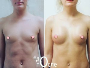 Фото до и после липолифтинга груди