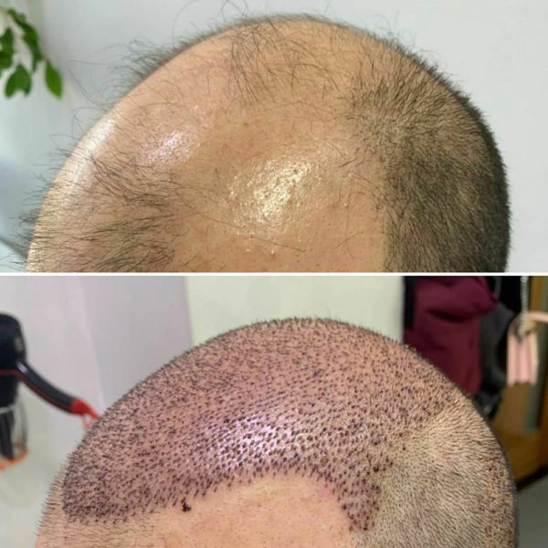 Пересадка волос с тела на голову