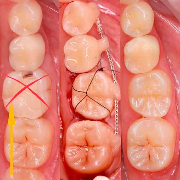 Фото до и после трансплантации зуба мудрости на место 1 моляра. Результат через 3 месяца.