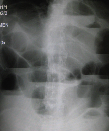 Обструкция тонкой кишки на рентгенограмме брюшной полости