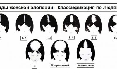 Андрогенетическая алопеция у женщин или выпадение волос по женскому типу