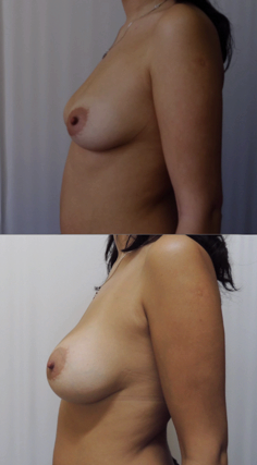 До и после маммопластики